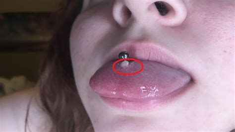 How To Get Rid Of A Tongue Piercing Bump YouTube