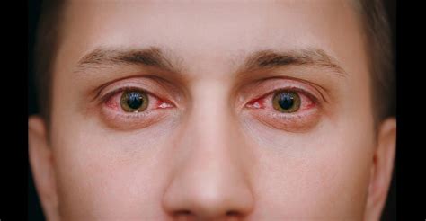 Pink Eye Conjunctivitis An Inside Look Into What It Is