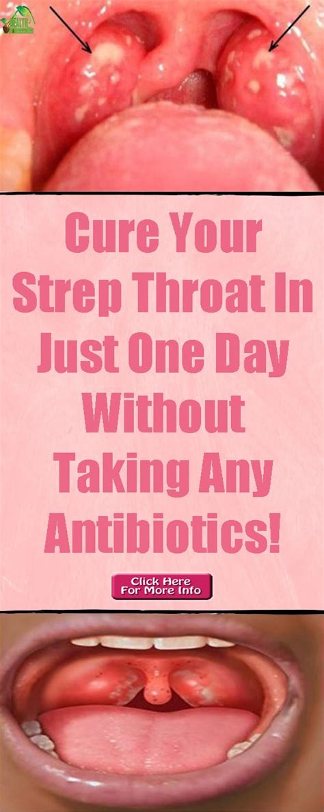 Strep Throat Is A Bacterial Infection That Mostly Occur In Children It