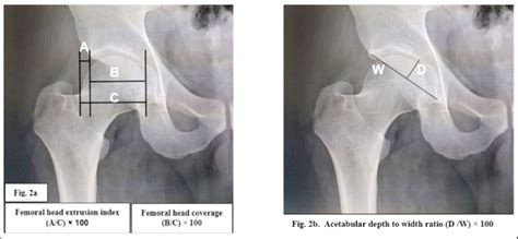 A Measurement Of Head Extrusion Index And Coverage B Acetabular