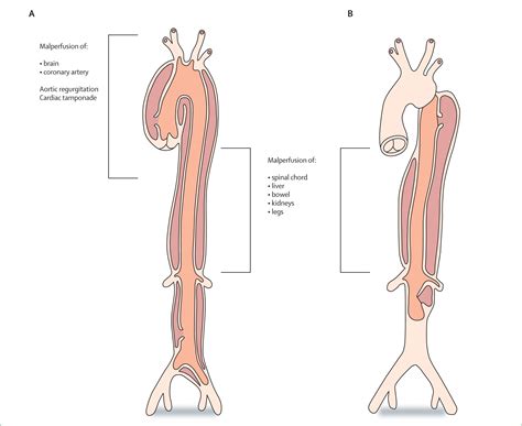 Acute Aortic Dissection The Lancet