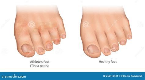 Illustration Of The Athlete S Foot And Healthy Foot Tinea Pedis Or