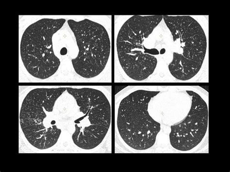 Pulmonary Sarcoidosis In A Year Old Man High Resolution Ct Hrct My