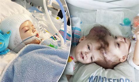 Conjoined Twins Anias And Jadon Mcdonald Are Finally Separated Health