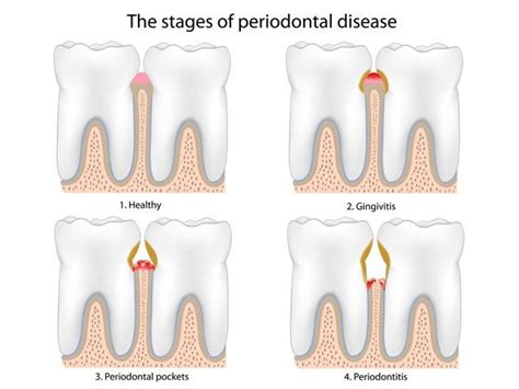What Is Periodontics Canyon Gate Dental Of Orem