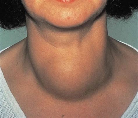 Thyroid Goiter Causes Symptoms Treatment Diagnosis And Prevention