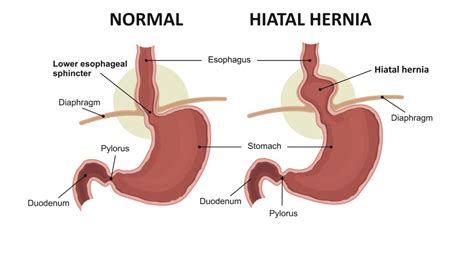 What S A Hiatal Hernia Bharat Pothuri Md Facg Gastroenterologist