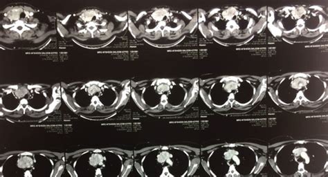 A Multiple Axial Sections Of Ct Scan Showing Retrosternal Extension