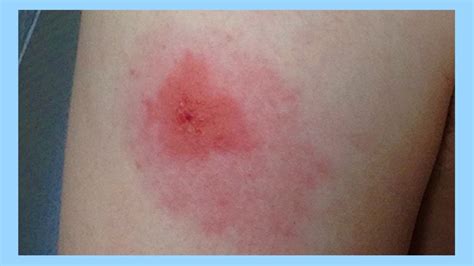 Spider Bites Spider Bites Pictures Symptoms And Treatment Spider