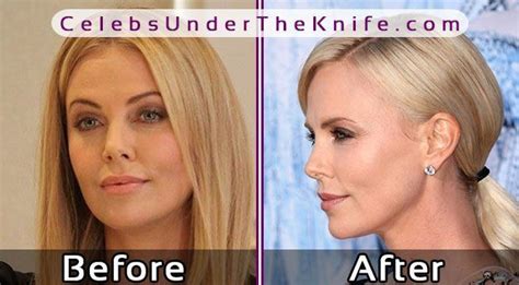 Charlize Theron Nose Job Photos Before After Plastic Surgery Celebrity Surgery Nose Job