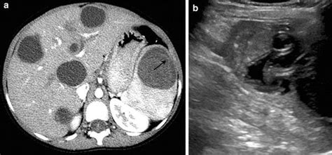 Echinococcal Disease A Axial Contrast Enhanced Ct Image Of A
