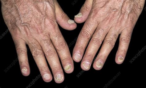 Fungal Infection Of The Fingernails Stock Image C0470373 Science