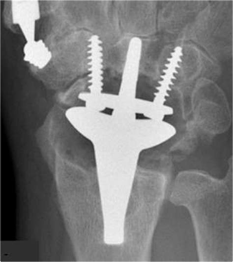 Periprosthetic Osteolysis After Total Wrist Arthroplasty Incidence
