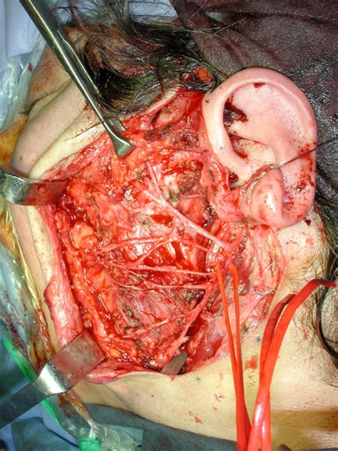 Salve sono un ragazzo di 28 anni, circa 8 mesi fa mi è stato diagnostica un adenoma pleomorfo di 1,5 cm alla parotide sx sto informandomi per effettuare l'operazione per. Recidiva dell'adenoma pleomorfo