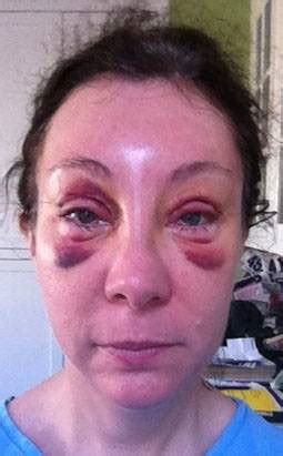 It is important to note that our eyes do reflect the lifestyles we lead, environmental factors and the ageing process. Eyelid Surgery - Plastic Surgery