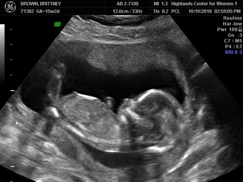 Tanner Wesley Brown 4 10 11 15 Week Ultrasound