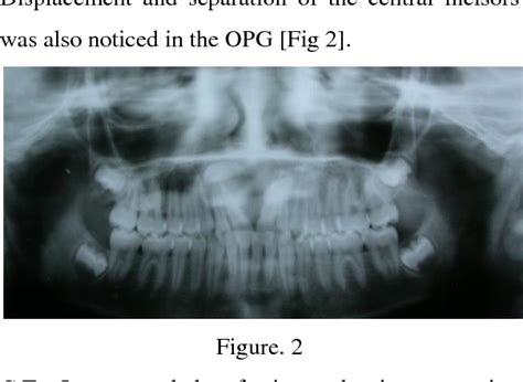 Figure 2 From Dentigerous Cyst Occuring In Maxilla Associated With