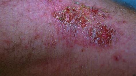 Common Bacterial Fungal And Viral Infections Of The Skin On Vimeo