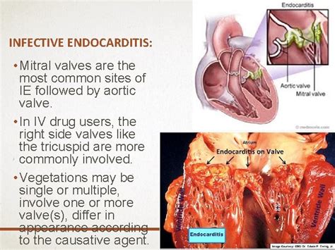 Pathology Of Rheumatic Heart Disease Infective Endocarditis And