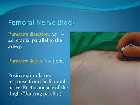 Ppt Peripheral Nerve Blocks Using Nerve Stimulator Powerpoint