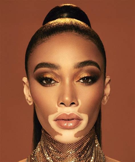 Emo Cunt⁷ On Twitter Vitiligo Model Model Face Winnie Harlow