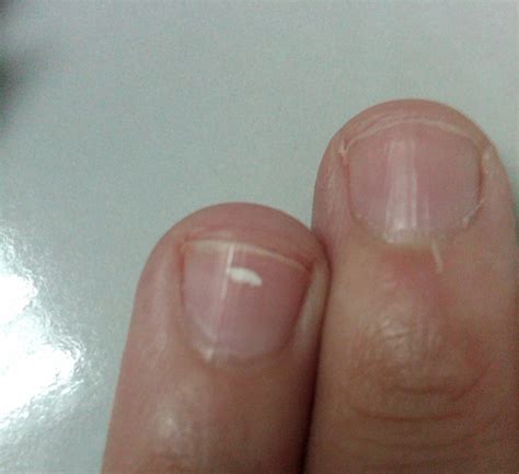 If You See A White Spot On Your Nail Heres What It Really Means