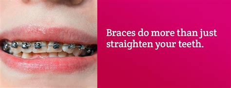 How long does it take to straighten teeth with braces? How Long Do Braces Take To Straighten Your Teeth - TeethWalls