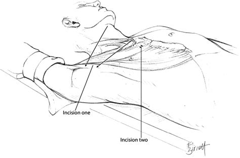 Figure From Robotic Thyroidectomy Operative Technique Using A
