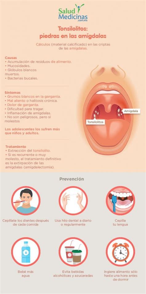Tonsilolitos ¿qué Son Causas Y Tratamientos Dentistas Cerca De Ti