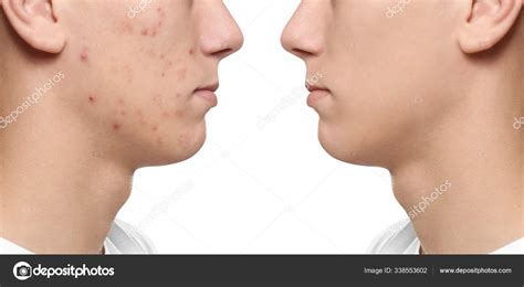 Teenager Acne Treatment White Background Closeup Stock Photo By