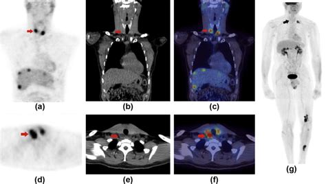 Clinical Significance Of Patterns Of Incidental Thyroid Uptake At 18f