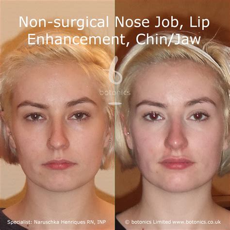 Non Surgical Nose Job Before And After Photos Comparison In London Uk