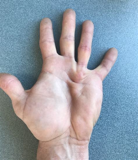 This Giant Lump In My Palm Pics