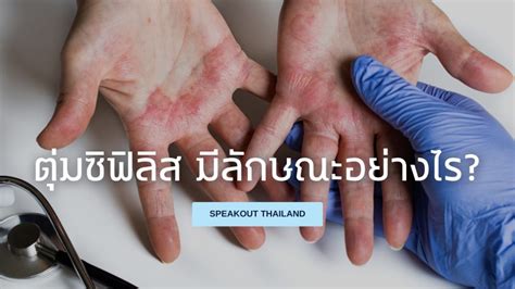 ตุ่มซิฟิลิส มีลักษณะอย่างไร Speak Out Thailand