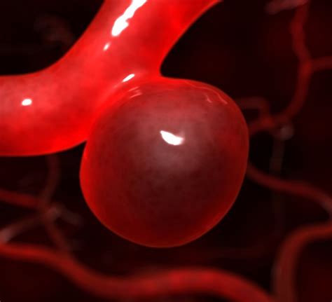 It may also burst or rupture, spilling blood into the surrounding tissue (called a hemorrhage). Qué es un aneurisma cerebral ? | Centro de Cirugía por ...