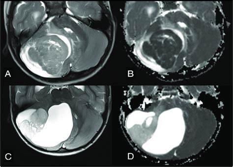 Differential Diagnoses In Cases Of Posterior Fossa Tumors Originating