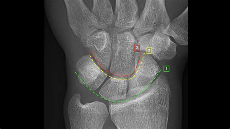 Wrist X Ray Interpretation Osce Guide Laptrinhx News