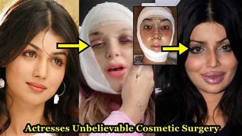 Best Plastic Surgery Before And After Bollywood