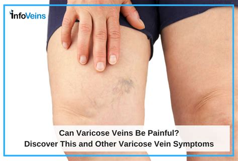 Varicose Veins Symptoms Pictures Damsnorne74 Blog