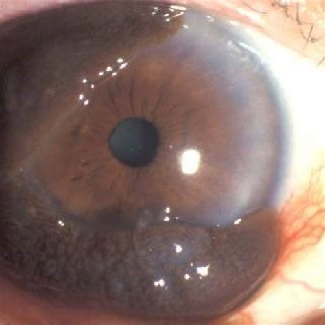Conjunctival Melanoma In The Eye Ocumel Uk