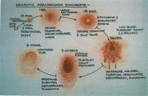 Spider Bite Progression Diagram From A Black Brown Widow Spider