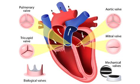 3 Benefits Of Having Keyhole Heart Surgery Vibe Verses
