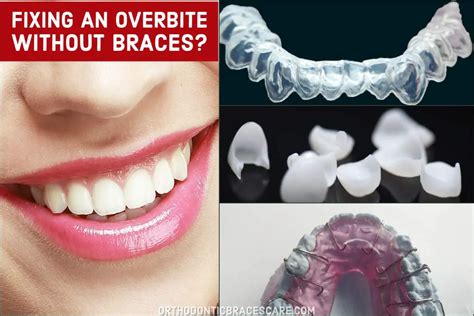 How To Fix An Overbite Without Braces Orthodontic Braces Care