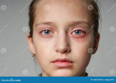 Réaction Allergique éruption Cutanée Portrait Proche De Vue Du Visage
