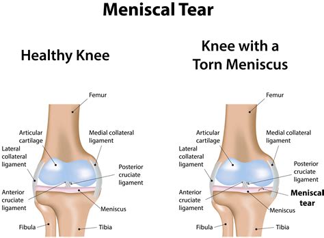 American technology, made in usa. All About Your Knee and Torn Meniscus