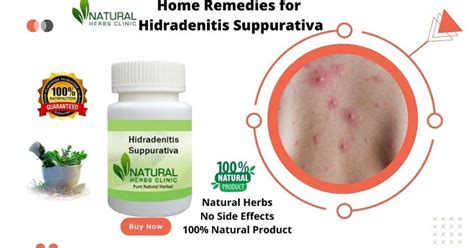 Natural Remedies For Hidradenitis Suppurativa