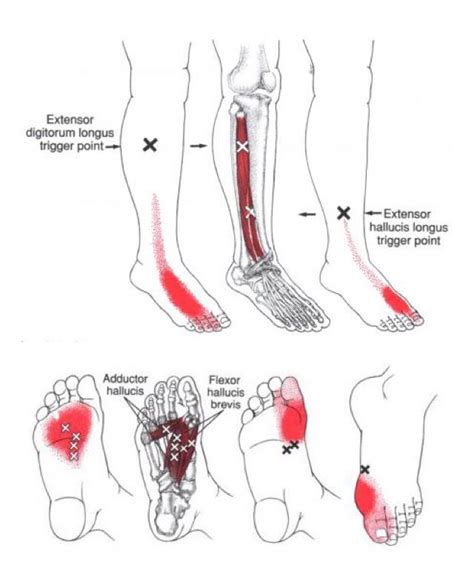 Pin On Health Myofascial Release Trigger Point