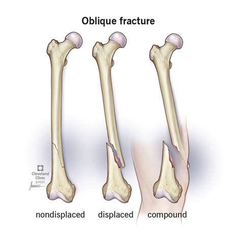 Oblique Fracture Symptoms Causes And Treatment
