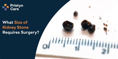 What Size Of Kidney Stone Requires Surgery Pristyn Care