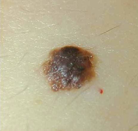 Hewan ini hidup dan dapat ditemukan di wilayah kering atau gurun di benua asia. Perbedaan Tahi Lalat dan Melanoma atau Kanker Kulit ...